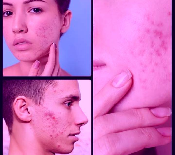 Celexa acne from celexa pharmacy