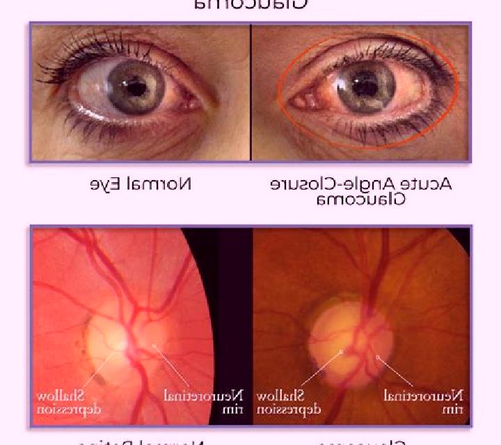 Celexa acute angle closure glaucoma celexa tablet