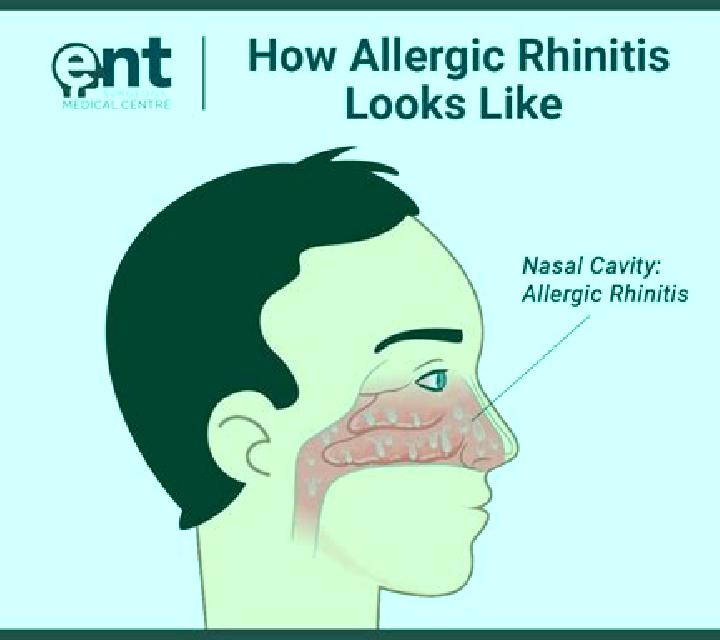 Celexa celexa causes non allergic rhinitis medication