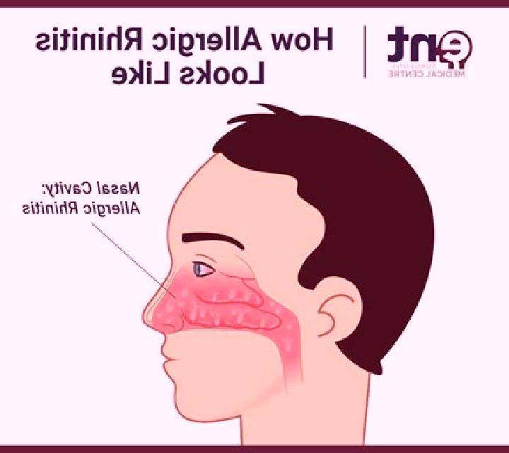 Celexa celexa causes non allergic rhinitis tablet