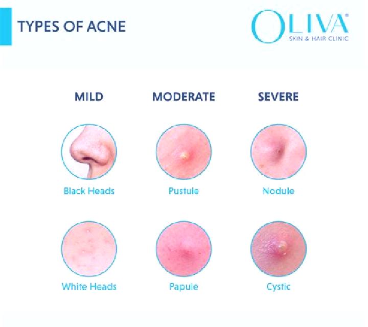 Celexa celexa causing cystic acne medication
