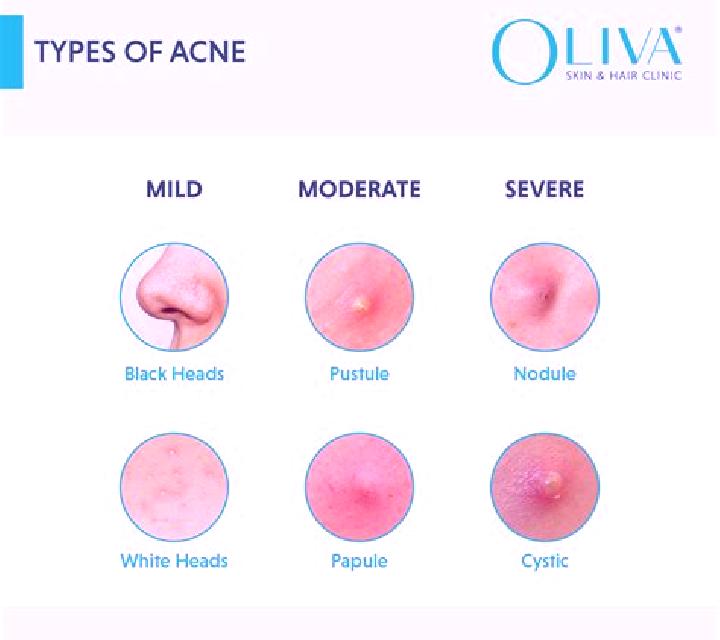 Celexa celexa causing cystic acne pills