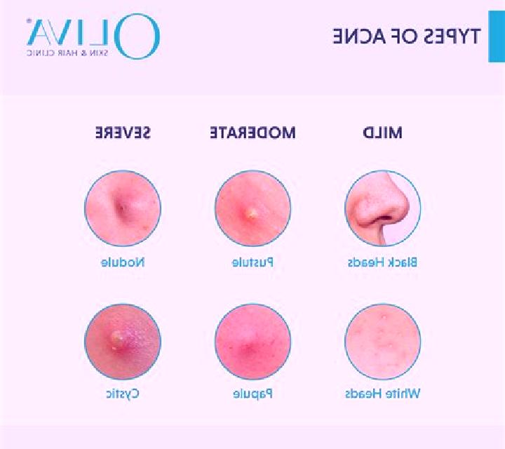 Celexa celexa causing cystic acne tablet