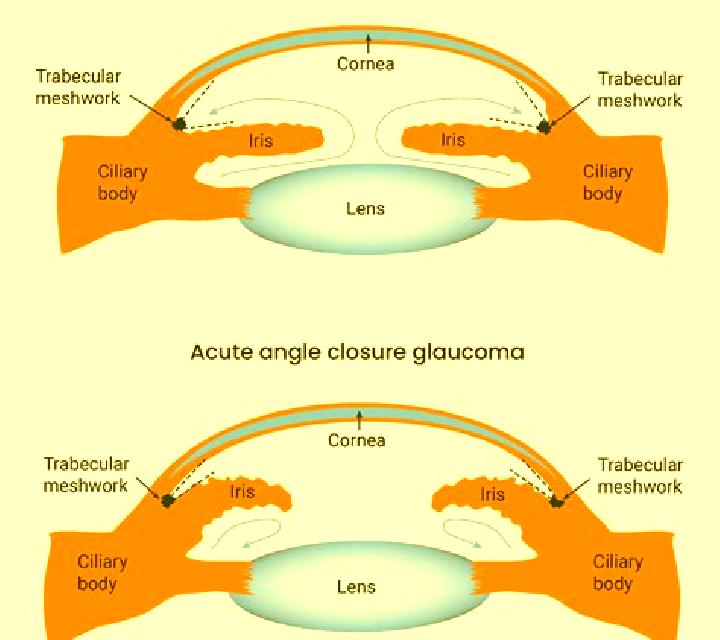 Celexa celexa open angle glaucoma pharmacy