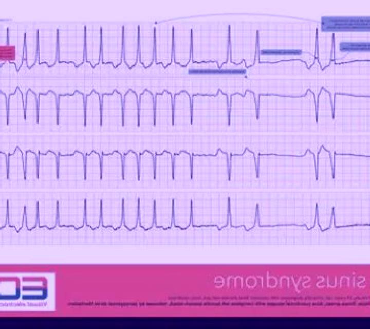 Celexa celexa sick sinus syndrome pharmacy