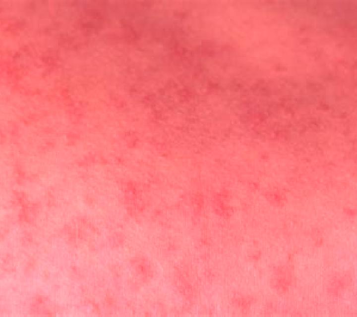 Celexa celexa skin rash pharmacy
