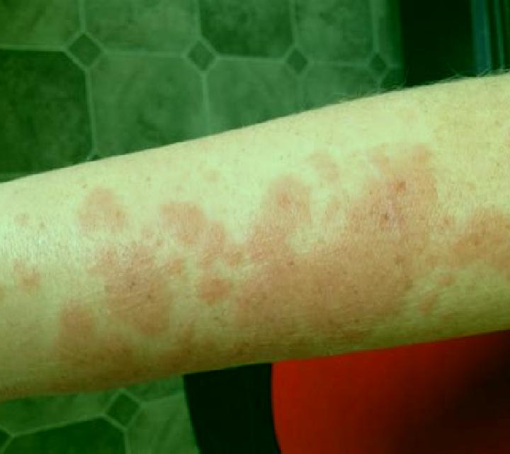 Celexa celexa sun sensitive medication