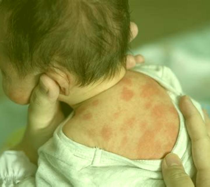 Celexa rash from celexa pharmacy