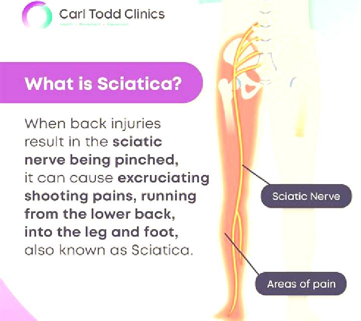 Cialis severe sciatica from cialis pills