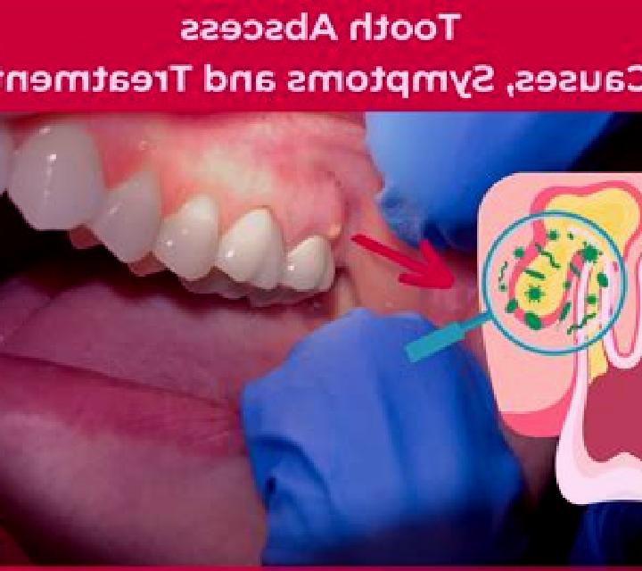 Flagyl flagyl abscess tooth medication