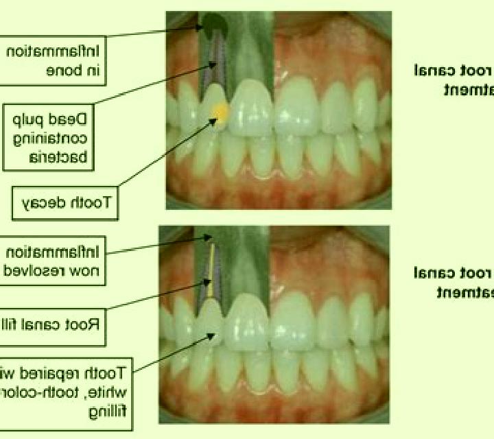 Flagyl flagyl before root canal pharmacy