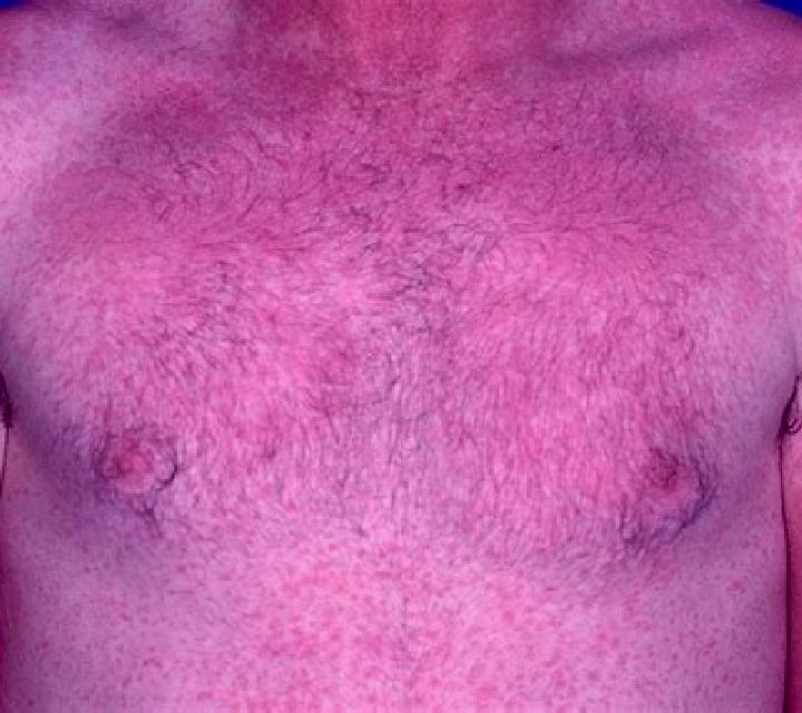Flagyl flagyl chest rash medication