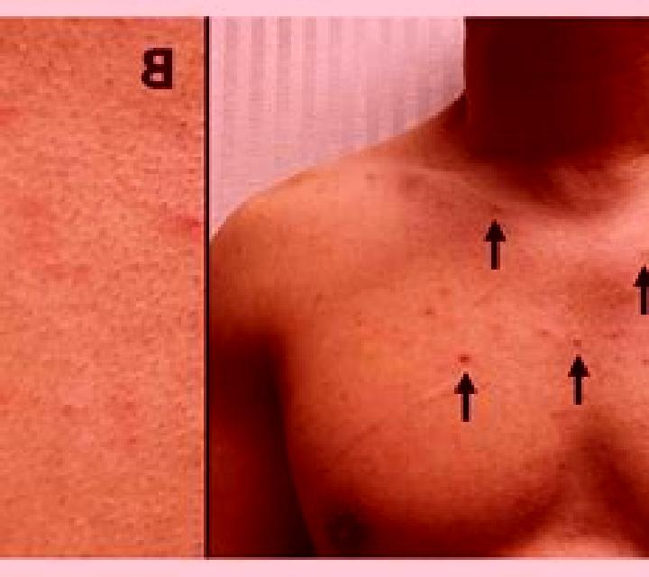 Flagyl flagyl chest rash pharmacy