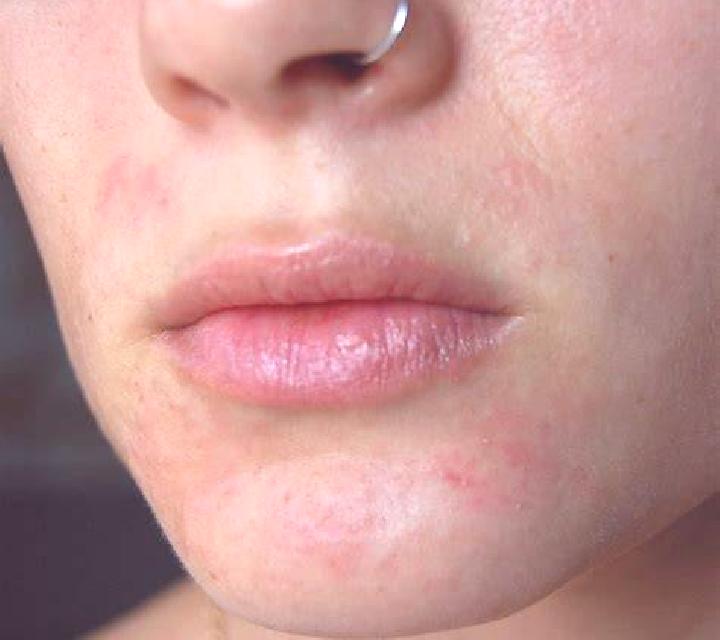 Flagyl flagyl for perioral dermatitis medication