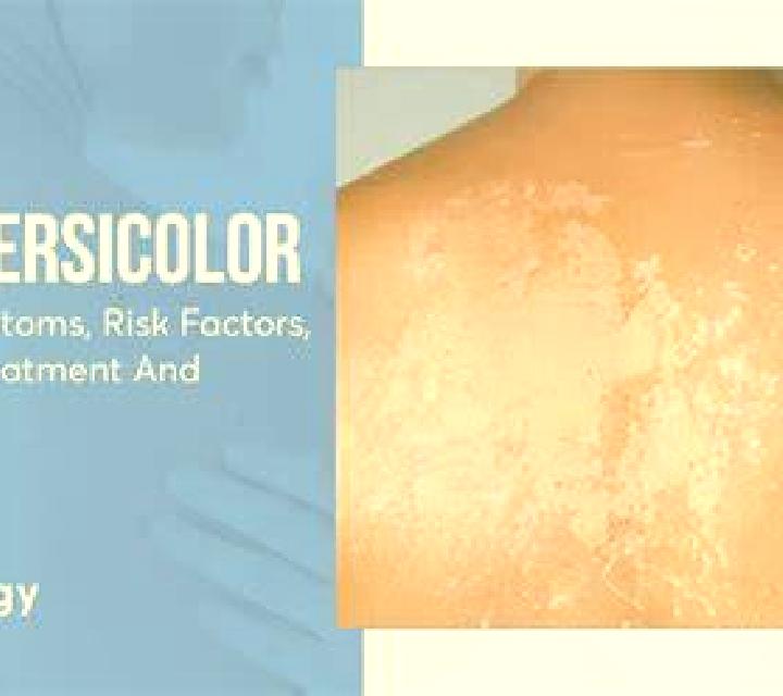Flagyl flagyl for tinea versicolor medication