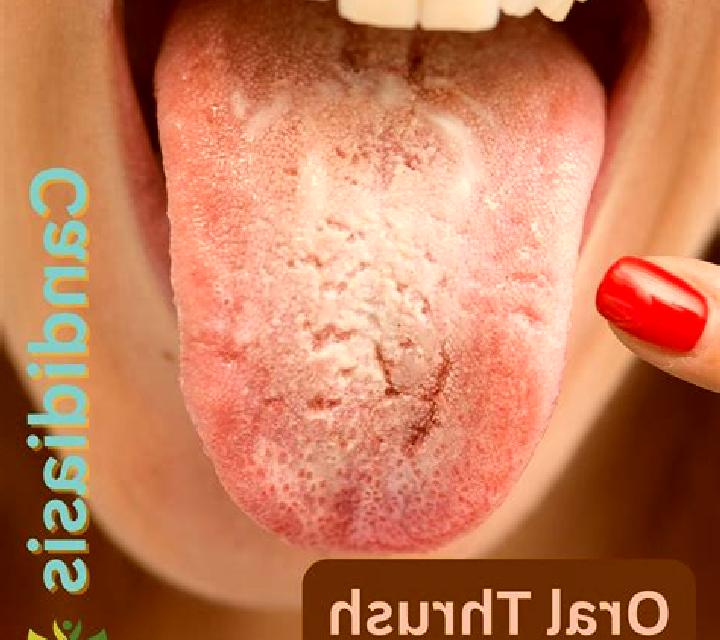 Flagyl thrush after flagyl pills