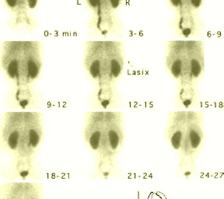 Lasix abnormal renal scan with lasix medication