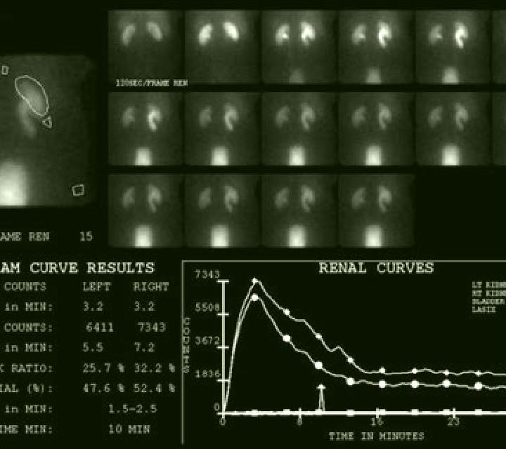 Lasix cpt code nm renal scan with lasix pharmacy