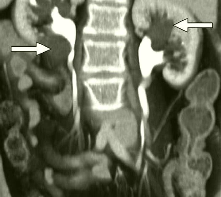 Lasix ct urogram with lasix tablet