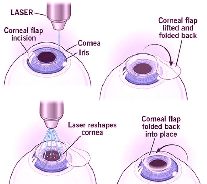 Lasix does lasix have lasers pharmacy