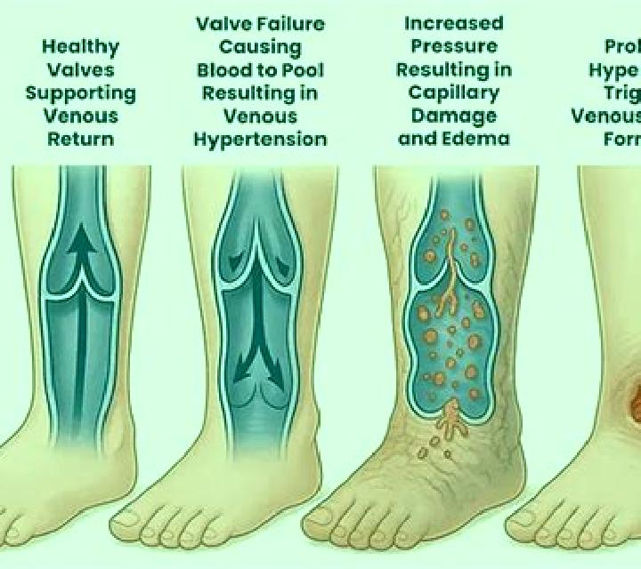 Lasix does lasix help venous insufficiency medication