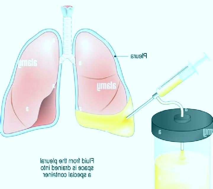 Lasix does lasix remove pleural pills
