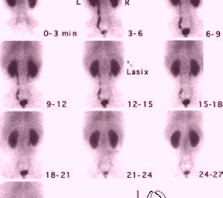 Lasix function renal scan with lasix pharmacy