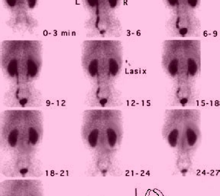 Lasix function renal scan with lasix tablet