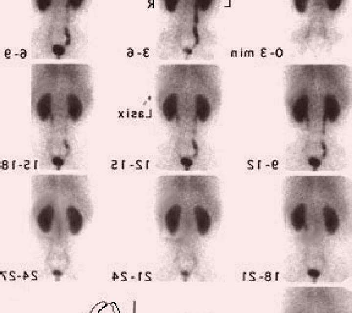 Lasix isotope renogram with lasix medication