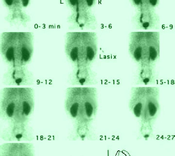 Lasix isotope renogram with lasix pharmacy