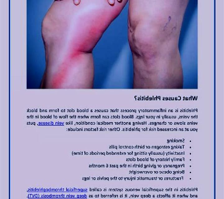 Lasix lasix and phlebitis pharmacy
