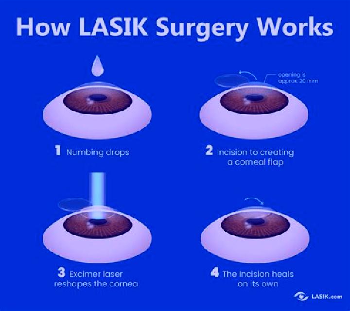 Lasix lasix cataract tablet