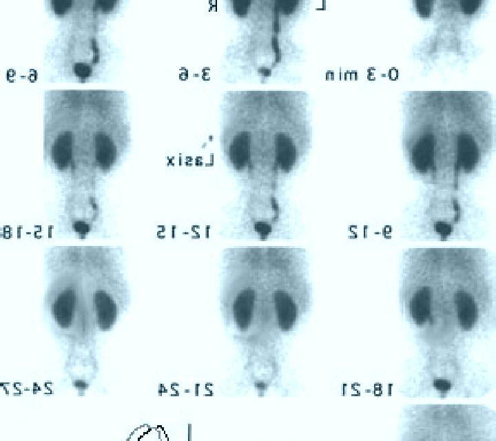 Lasix lasix nuclear renal scan medication