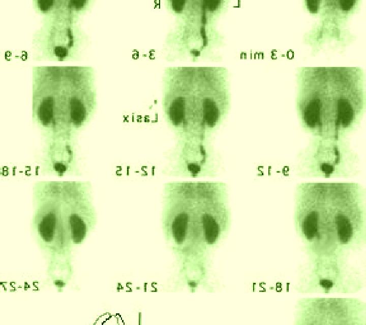Lasix lasix renal scan renal function values 31 69 medication