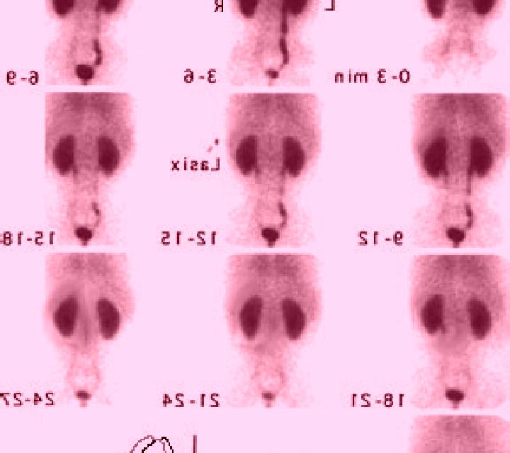 Lasix lasix renal scan renal function values 31 69 pharmacy