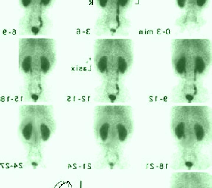 Lasix lasix renogram results pharmacy