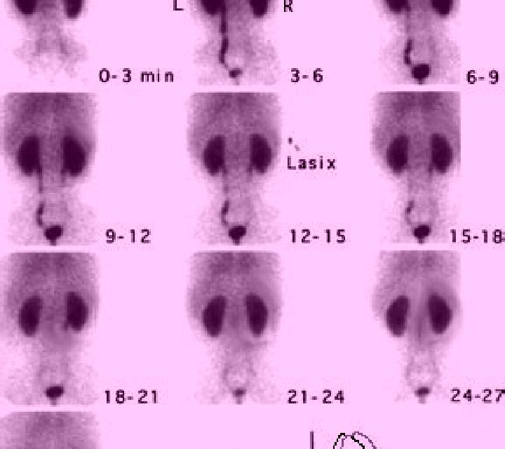 Lasix mag3 lasix renogram tablet