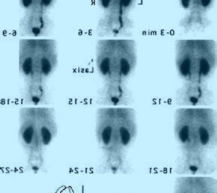 Lasix nm renal scan with lasix cpt code pharmacy