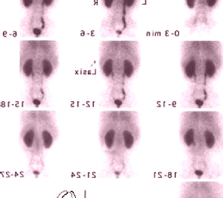 Lasix nm renogram with lasix cpt code pharmacy