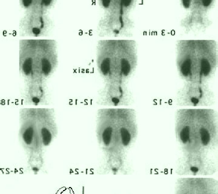 Lasix nuclear lasix renogram pharmacy