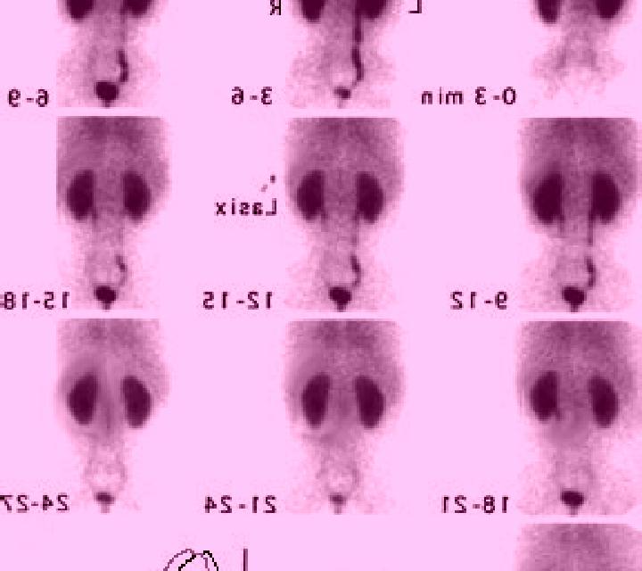 Lasix nuclear lasix renogram tablet