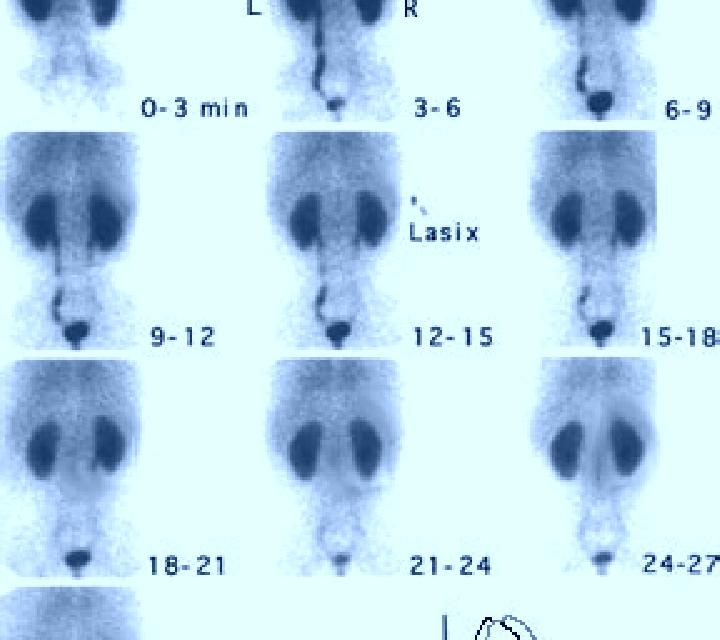 Lasix renal flow scan with lasix medication