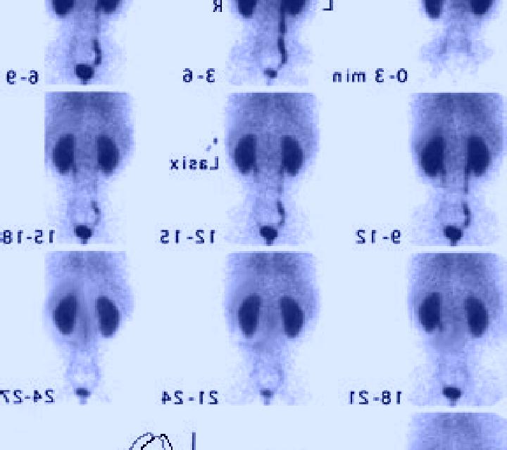 Lasix what is a renogram with lasix tablet