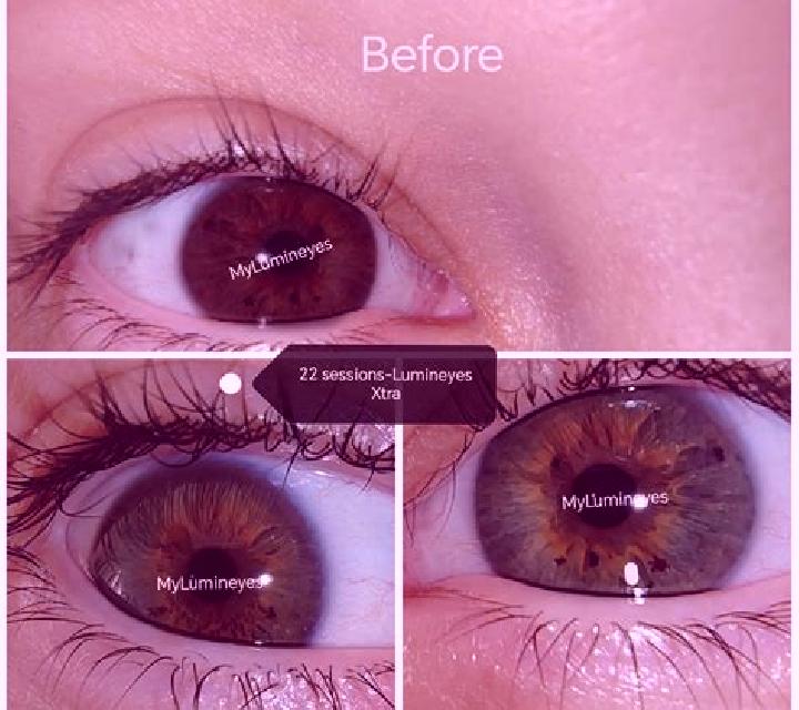 Levitra levitra eye damage pills