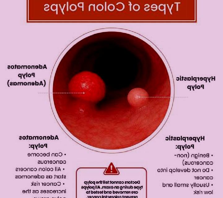 Prednisolone does prednisolone affect colon polyps medication