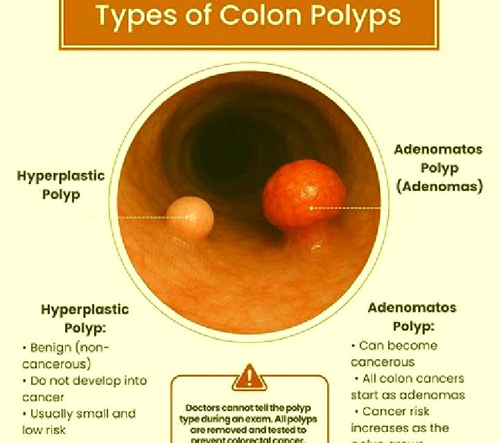 Prednisolone does prednisolone affect colon polyps pharmacy