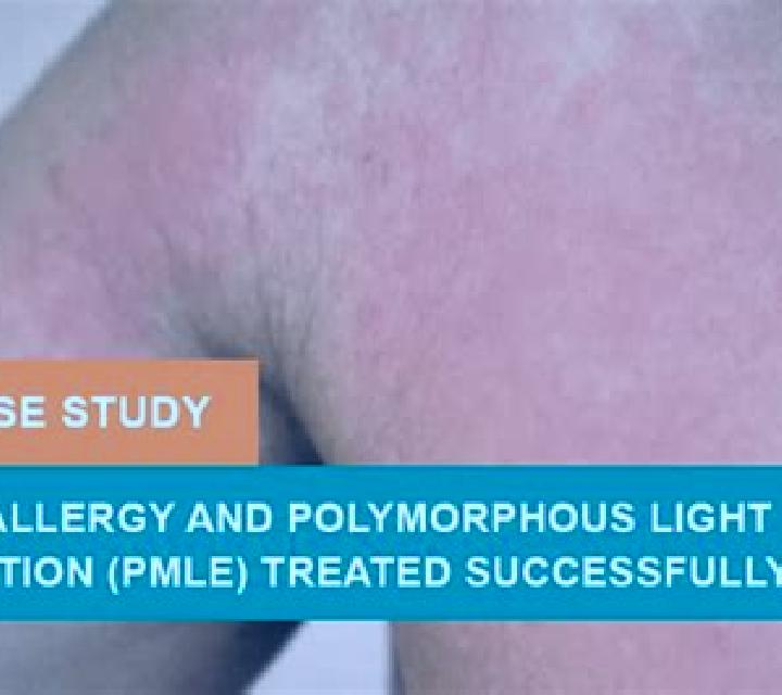 Prednisolone polymorphic light eruption prednisolone medication
