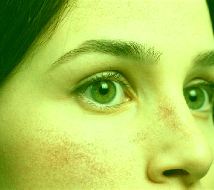 Prednisolone red cheeks from prednisolone tablet