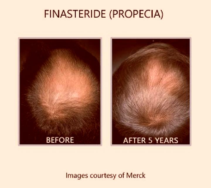 Propecia difference between propecia and generic finasteride tablet