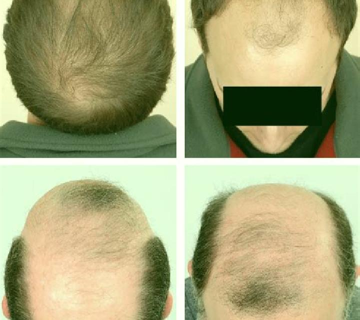 Propecia diffuse patterned alopecia propecia medication